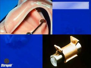 Hader Bar How to Make a New Denture on an Old Bar