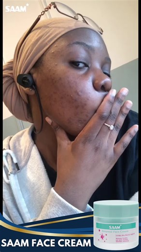 Say Goodbye to Pigmentation with Saam Face Cream