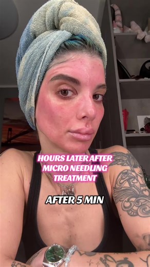 Transform Your Skin: Micro Needling Results Explained
