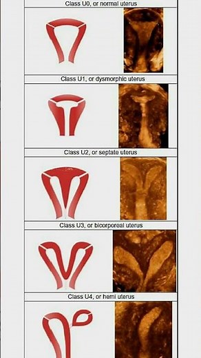 Understanding Uterine Anomalies: Classifications of Normal and Abnormal Uterus Shapes #gyne