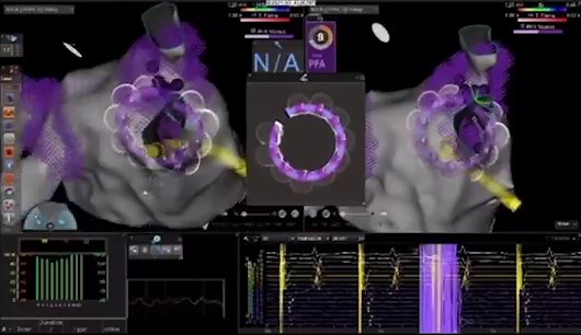 VARIPULSE PFA Catheter with VIZIGO and CARTO 3 for precise ablation and no fluoroscopy. | Christopher Jones posted on the topic | LinkedIn