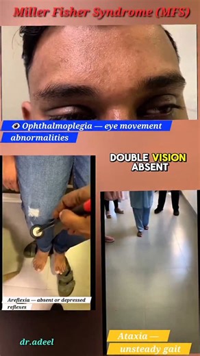 Adeel Ur Rehman | Miller Fisher Syndrome: Rare GBS Variant You Shouldn’t Miss 👁️🦵🚶‍♂️ Double vision, absent reflexes, and trouble walking? This is Miller... | Instagram