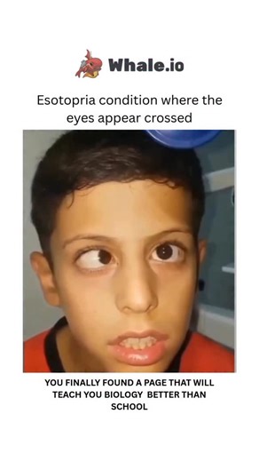 BIOLOGY | MEDICAL | HEALTH on Instagram: "Esotropia (Crossed Eyes, Lazy Eye or Squint)Esotropia, or “crossed eyes,” is an eye condition where one or both eyes turn inward toward the nose, a type of strabismus. It is common in infants and children but can occur at any age, and if left untreated, it can lead to serious vision problems like amblyopia (lazy eye) and poor depth perception. Treatment often involves corrective lenses, vision therapy, or eye muscle surgery, depending on the underlying c