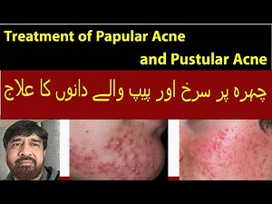How to Get Rid of Pustules & Papules: Best Treatments for Red Acne Bumps.Stop Popping! Treat Acne.