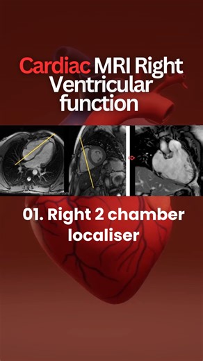 Cardiac MRI Right Ventricular Function #CardiacMRI #mri #Radiographer #ctscanner #cttechnologist #cttech #Diagnostic #MedicalEducation #MRISCAN #ctscantech #radiography #radiology #radiologia #xray #radiologytech #XRaytechnician #medicaltechnologist #MedicalTech #radiologist #radtech #radiologylife #medical #anatomy #doctor #medicalimaging | Maruf Bhuiyan The Radiographer