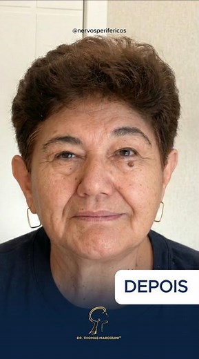 Surgery for Sequelae of Facial Paralysis