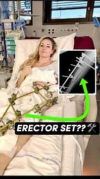 Why did Lindsey Vonn need a Spanning External Fixator?? Doctor explains (pt 4) #Trauma #Surgery