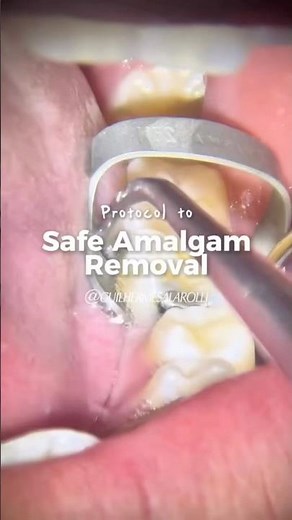 Safe amalgam removal protocol #dentist