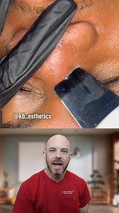 74K views · 207 reactions | This pore spatula is lifting out some serious gunk! 﫧 (credit: @kb_esthetics on TT) #satisfying #fyp | Dr. Dustin Portela, Dermatologist | Facebook