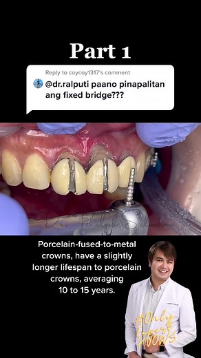 Understanding PFM Dental Crowns and Bridges | Expert Guide