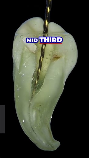 Mastering Rotary Files Navigating Deep Curved Canals