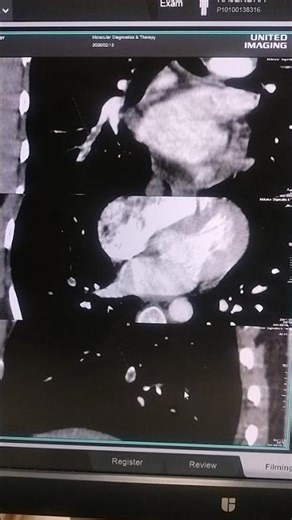 Pulmonary Angiography