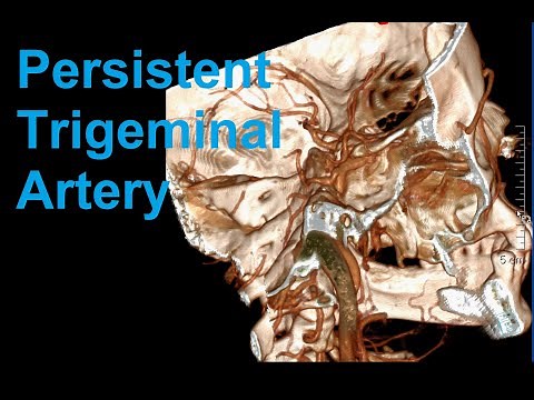 Persistent Trigeminal Artery: 3D Reconstruction of Anatomy