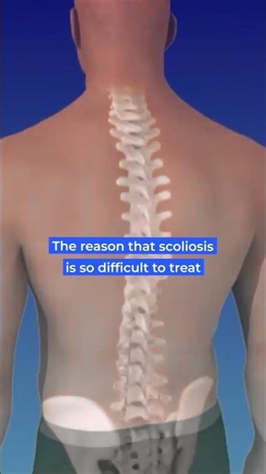 Why is scoliosis is so difficult to treat?