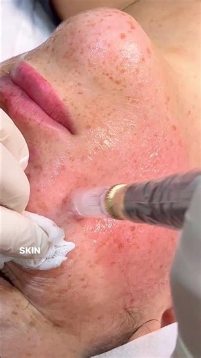 Skin Needling Explained in Under 20 Seconds