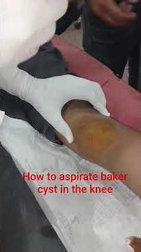 aspiration technique of baker cyst in the knee explaination given by Dr akhilesh #trendingvideo