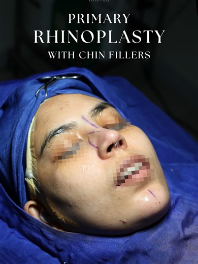 A smoother profile. A stronger balance ✨ Post-op results combining rhinoplasty and chin filler for subtle yet impactful refinement. 📅 Inquire today. #Rhinoplasty #BeforeAndAfter #RhinoplastyPhilippines #MerakiEsthetique