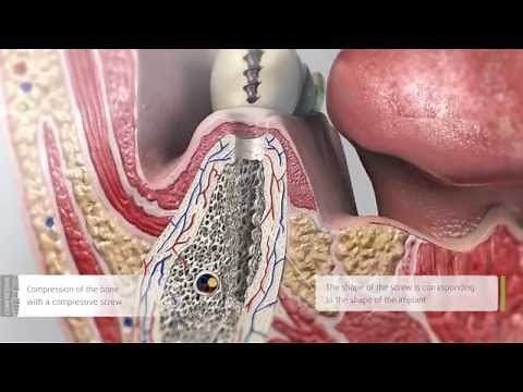 Dental implant ROOTT Compressive