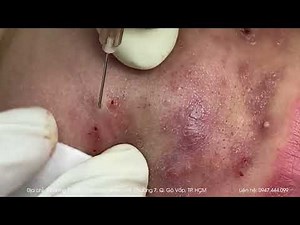 Big Cystic Acne Blackheads Extraction Blackheads & Milia, Whiteheads Removal Pimple Popping