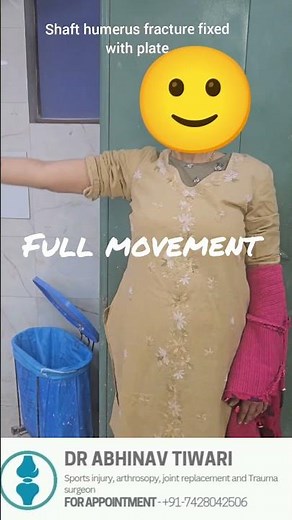 humerus (arm ) shaft fracture treatment and recovery #humerus #fracturerecovery #fracturetreatment