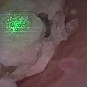 Right ureteroscopy laser lithotripsy - retained ureteral stent