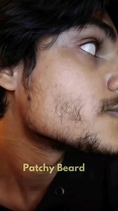 🔍 Looking for a thick and dense beard? Don’t worry we got your back. Try our latest minoxidil formulation. 💊 5% Minoxidil for hassle-free, No side effects! 🥑 Derma roller to activate the follicles 🍬 Gummies to make the beard thicker and fuller= | Hair Matters by Man Matters