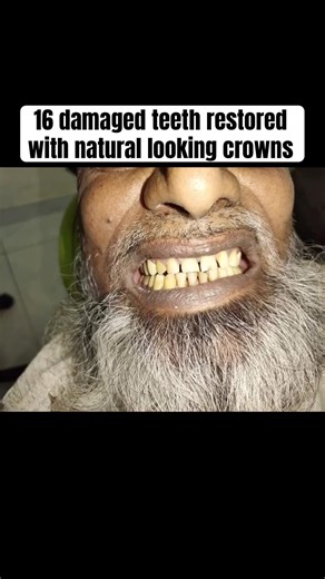 16 Damaged teeth restored with natural looking crowns | Green Park Dental Hospital #shorts #ytshorts