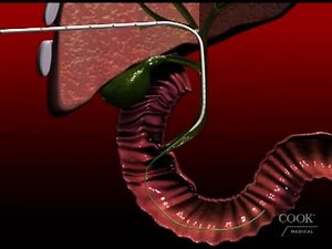 Biliary Drainage Catheter insertion animation