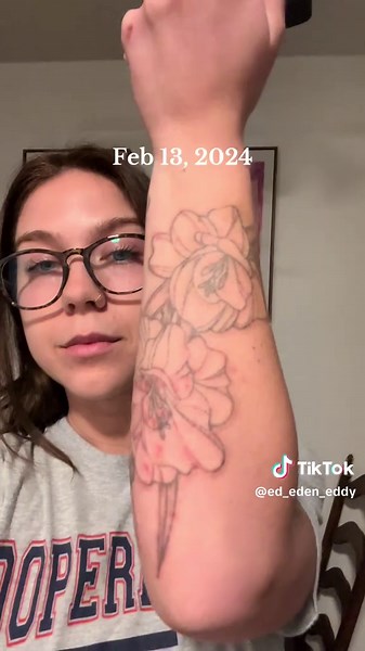 Tattoo Removal: Results After One Year of Treatment