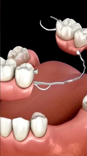 Animated Removable Partial Denture