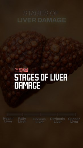 Stages of Liver Damage -Liver damage develops slowly, often showing no clear signs until serious harm sets in. #fblifestyle | The Brain Maze