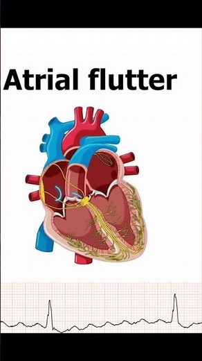 Atrial Flutter #medical #cardiaccycle #heart #cardiology #doctor