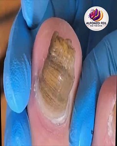 6.1K views · 42 reactions | Trusted Best Care Practices for Diabetic Nails #WellnessSeniors #SeniorHealth #SimpleHealthTricks | Alfonzo Feil | Facebook