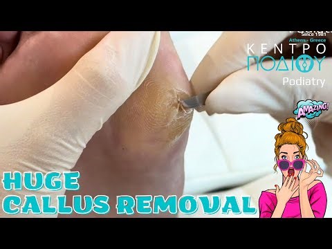 Huge Callus Removal|Κάλοι|Ποδολογία #podology #kentropodiou #κεντροποδιου #podologia #podiatry