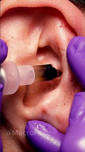The Cleanest Ear Extraction You’ll See Today
