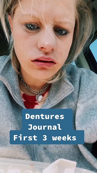 #dentist #dentures #pain #teethextraction #fyp