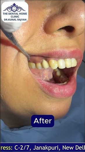 Restore Your Smile with Dental Implants | Painless, Fixed & Long-Lasting Solution – The Dental Home