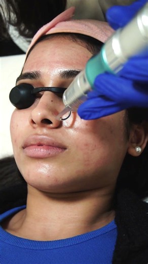 Why Q-Switch Laser Treatment | Idha