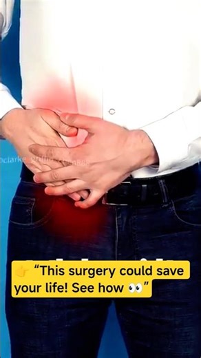 Appendectomy (Appendix Removal)#shorts#