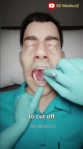 Uvula incision procedure (Uvulectomy) \\\\ Uvula cutting surgery 🥼 #medico #shortvideo #ytshorts #msn