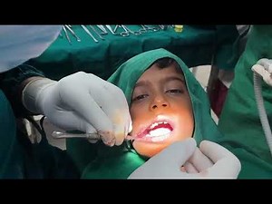 Demonstration of Marsupialization of periapical cyst by Dr Prashanth N T