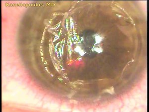 Extreme Lasik Epithelial Ingrowth Examples - Eyetube