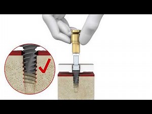 Latest Dental Implant Technology - NobelGuide with NobelActive Manual Insertion
