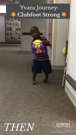 Clubfoot to Football Field 🌟 Born with clubfoot, this brave clubfoot warrior first steps in life were full of challenges. Walking was painful, running seemed impossible, and many would have thought his future was already written. But his story is proof that disability does not define you — determination does. 💪⚽ With the right treatment, relentless courage, and the support of those who believed in him, he didn’t just learn to walk straight — he ran, chased his dreams, and today he shines as an