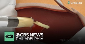 FDA clears new way to stop severe bleeding in seconds