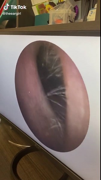 Do you want to see what happens next? Where’s my viewers!? #earwax #theeargirl #earwaxremoval #gross #fyp #hearing