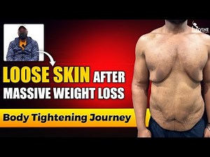 Loose Skin After Massive Weight Loss: Body Tightening Journey