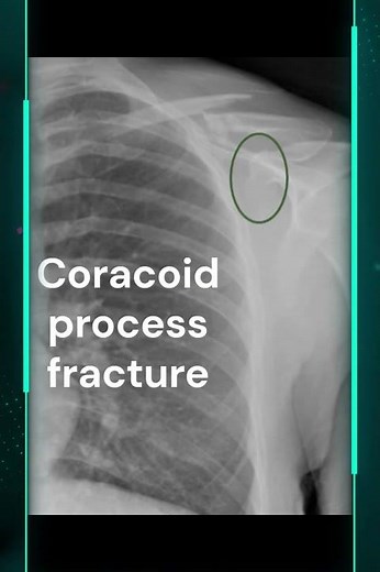 Coracoid process fracture with distal third of clavicle fracture