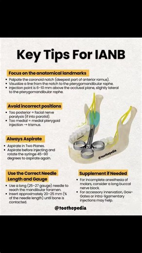 Toothopedia on Instagram: "Struggling with Inferior Alveolar Nerve Blocks (IANB)? Get your questions answered with these key tips! Learn to focus on anatomical landmarks, avoid incorrect positions, always aspirate correctly, and use the right needle. Discover how to supplement for complete anesthesia in this essential dental guide. #aspirations #oralhealth #explorepage✨ #viralreels #contentcreator"