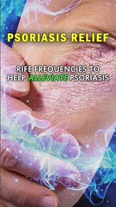 Psoriasis Relief with RIFE Frequencies